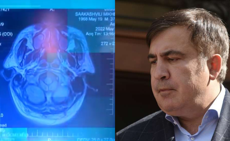 სააკაშვილის ექსპერტიზა დასრულდა - დაავადება ესადაგება პატიმრობიდან გათავისუფლებას