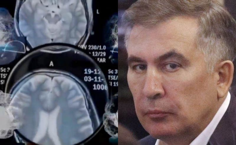 "შესაძლებელია უეცარი სიკვდილიც" - მედიკოსები სააკაშვილის ორგანიზმში მძიმე მეტალების აღმოჩენაზე